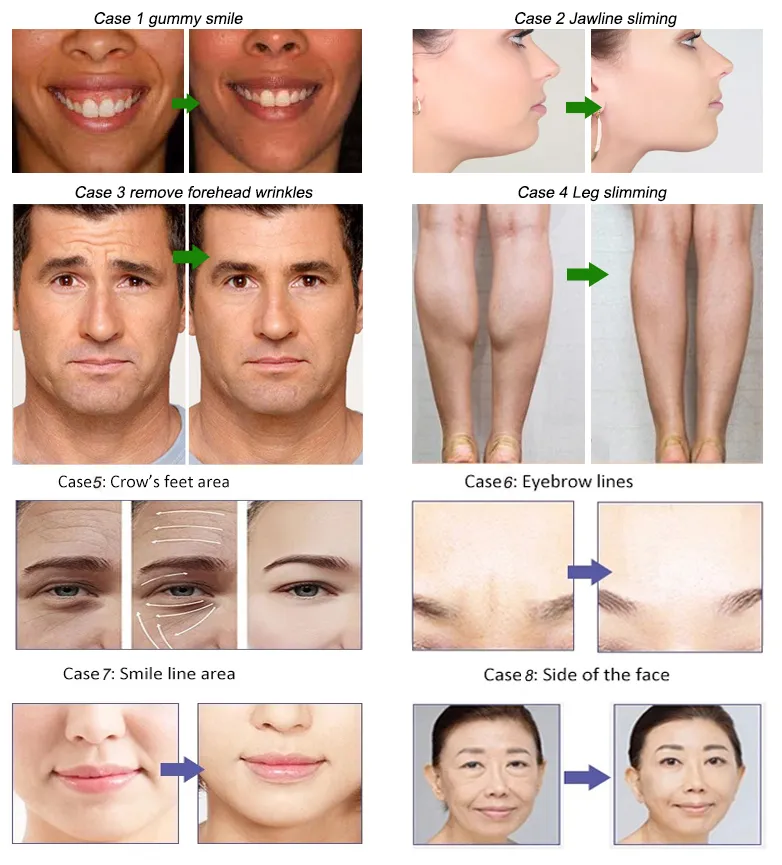 Schlankheitsmittel gegen Falten Beutox Batulaxs Resty Hautfüllmittel Juvederms 1